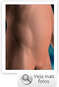 Lipoaspiração